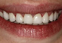 Gemma Worn Teeth After