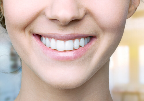 cosmetic smile mini-makeover